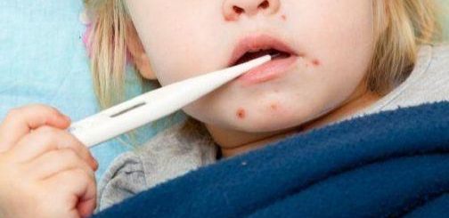 Image result for Measles outbreak in Ocean County