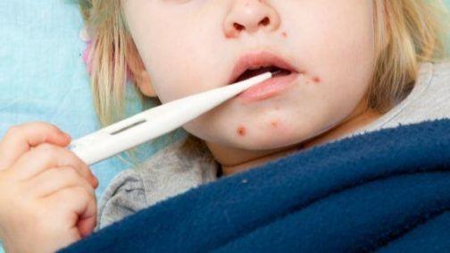 Image result for Measles outbreak in Ocean County