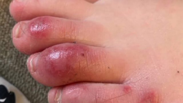 COVID toes\\\\': Puzzling condition a possible coronavirus symptom in ...